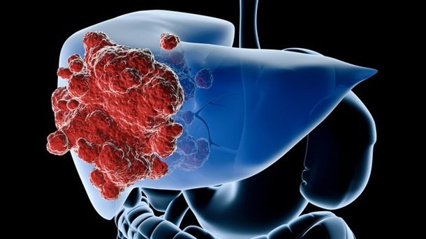 Científicos descubren posible vía para frenar cáncer de hígado