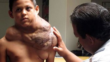 operan a nino de un mega tumor en el cuello