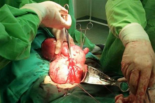 Pensó que estaba por dar a luz pero le extrajeron un tumor de casi 5 kilos