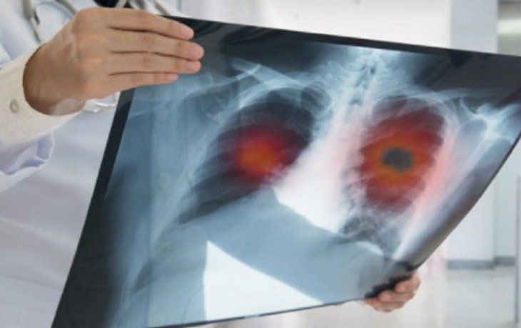 Aseguran que los pulmones de quienes superan el coronavirus quedan peor que los de los fumadores