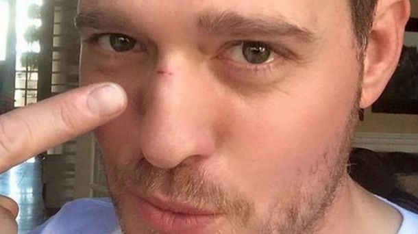Michael Bublé sorprendió en las redes sociales con su rostro lastimado