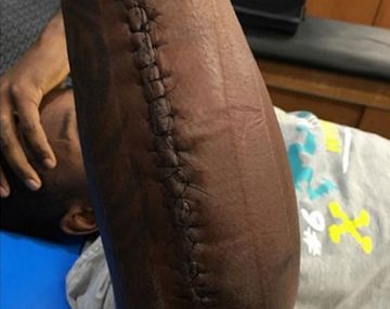 Impresionante: jugó el Super Bowl con el brazo quebrado