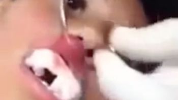 insolito: sentia dolor en el labio y le sacaron un gusano insolito: sentia dolor en el labio y le sacaron un gusano