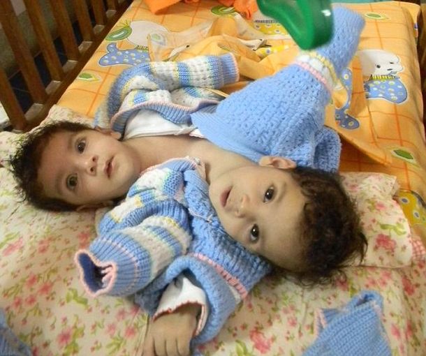 Aradhana y Stuti nacieron unidas por el vientre