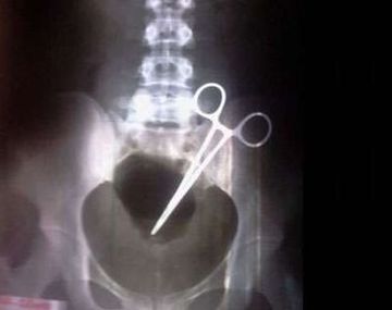 Una mujer vive con una tijera en el abdomen hace 9 meses