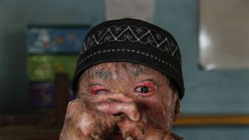 el caso del chico serpiente: cambia de piel cada 40 dias el caso del chico serpiente: cambia de piel cada 40 dias