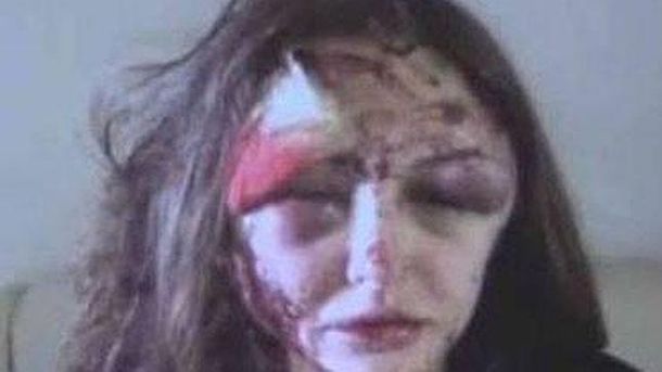 Un millonario ruso desfiguró a su novia por querer terminar la relación que tenía con él