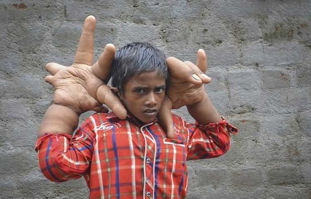 Sorpresa en la India por el caso de un niño que tiene las manos gigantes