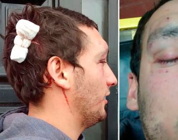 Fue a bailar a una disco y patovica lo desfiguró