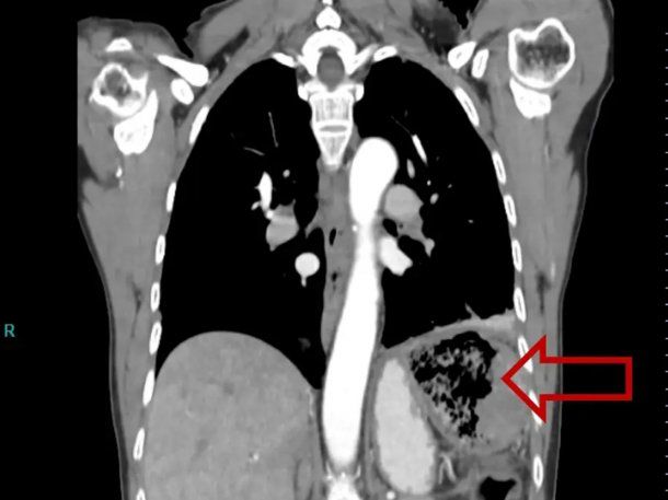 Insólito: una mujer vivió 20 años con una gasa en el intestino