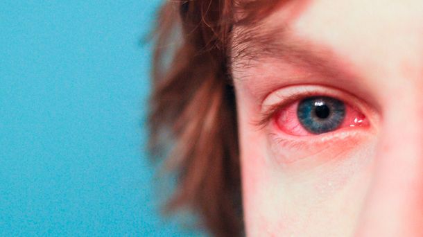 Alertan por una conjuntivitis que puede durar hasta un mes y dejar secuelas
