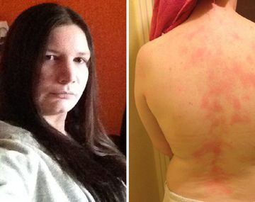 Una extraña enfermedad la hace alérgica