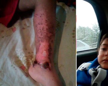 Caminaba por la vereda y terminó con una pierna quemada con ácido