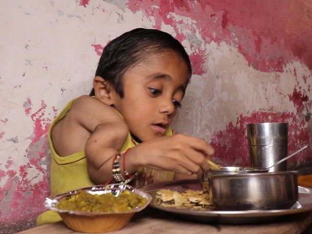 La impactante historia del niño hecho de vidrio: tiene rotos 100 huesos por una rara enfermedad