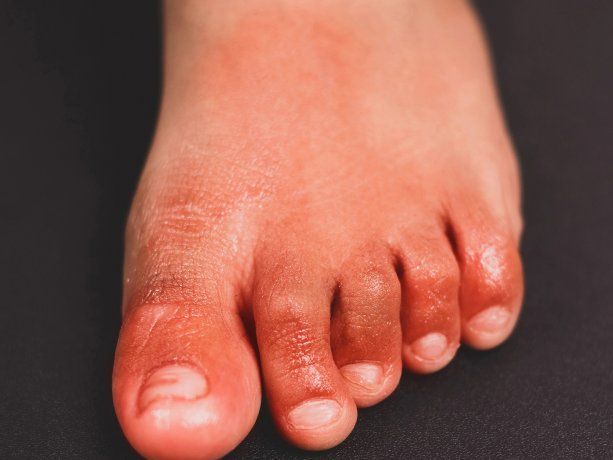 Detectaron un insólito síntoma en los pies de pacientes infectados con Ómicron