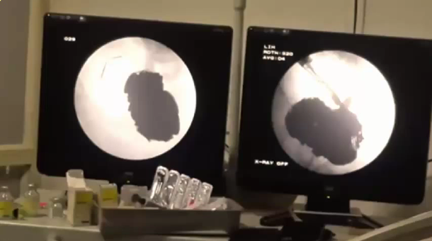 Un hombre comía clavos y monedas porque estaba deprimido