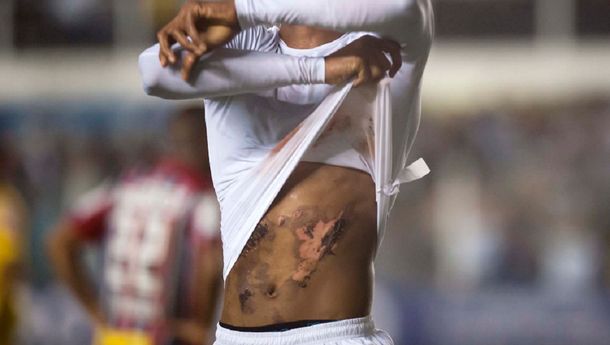 Jonathan Copete hizo tres goles en Santos e impresionó con quemaduras en su cuerpo