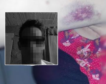 Le pegó durante su tratamiento oncológico