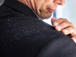 Cómo eliminar la caspa a partir de un método casero Cómo eliminar la caspa a partir de un método casero