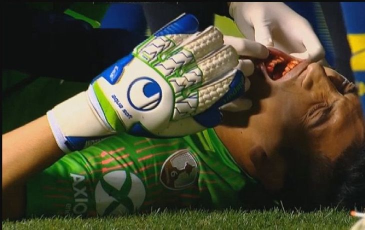 Esteban Andrada sufrió un fuerte golpe en su rostro