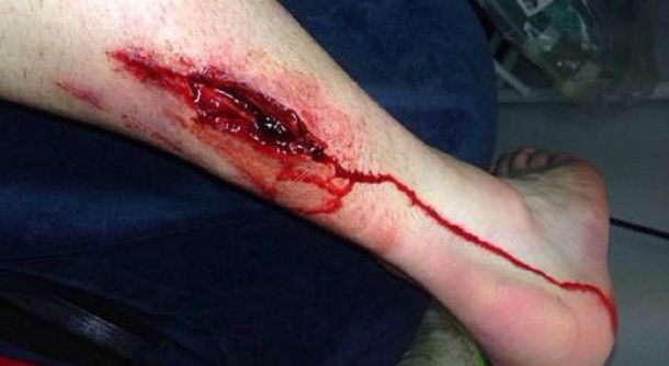 Por una brutal patada, un jugador recibió 13 puntos de sutura