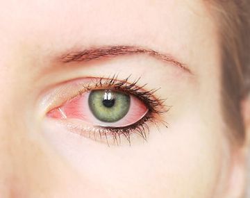 Claves para prevenir la alergia ocular