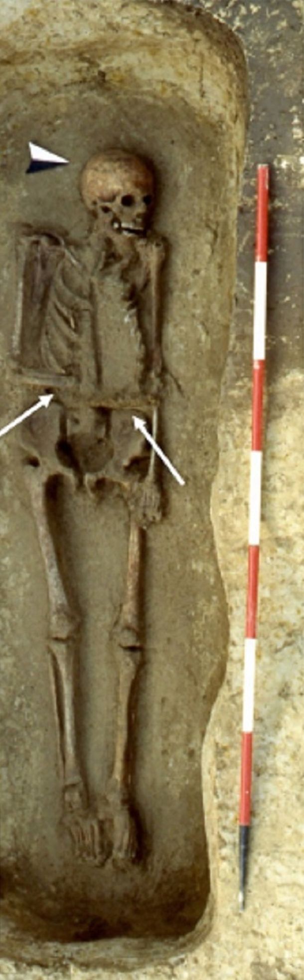 Encuentran los restos más antiguos de un hombre que usaba una prótesis