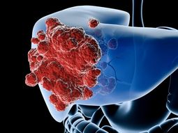 Científicos descubren posible vía para frenar cáncer de hígado