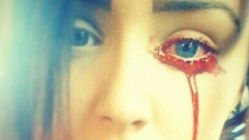 una adolescente de inglaterra no para de sangrar por los ojos y no saben por que una adolescente de inglaterra no para de sangrar por los ojos y no saben por que