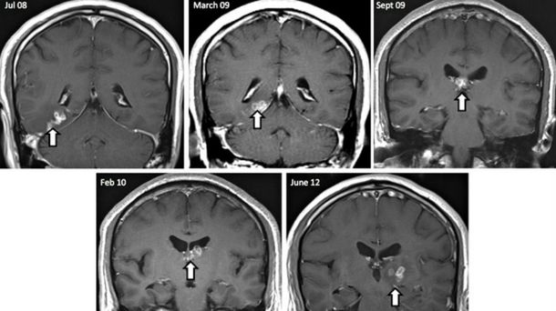 Un hombre estuvo más de cuatro años con un gusano en su cabeza
