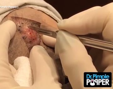 Dr Pimple Popper extrañe un muñeco de nieve de un hombre