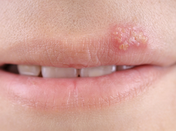 herpes: los consejos para prevenir la infeccion herpes: los consejos para prevenir la infeccion