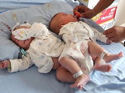 separan a siamesas con la ayuda de la impresion 3d separan a siamesas con la ayuda de la impresion 3d