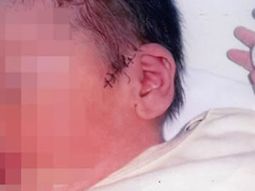 Casi le amputan la oreja a un bebé durante una cesárea