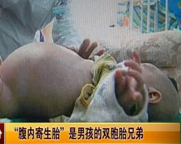 Niño de 2 años estuvo embarazado de su hermano mellizo
