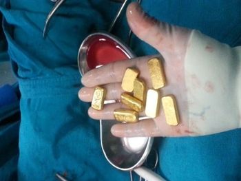 Lo operaron de urgencia por dolor abdominal y le encontraron un tesoro