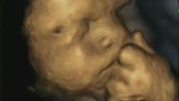 ¿Cómo es la cara de un feto cuando su madre sufre estrés?