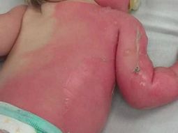 un bebe sufrio quemaduras porque su mama lo rocio con agua hirviendo un bebe sufrio quemaduras porque su mama lo rocio con agua hirviendo