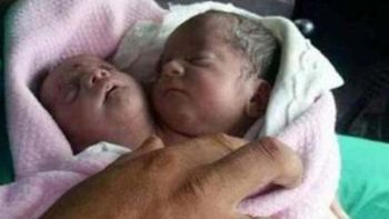 Nació un bebé con dos cabezas en Siria Nació un bebé con dos cabezas en Siria