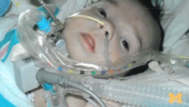 Un bebé sobrevive gracias a una impresora 3D