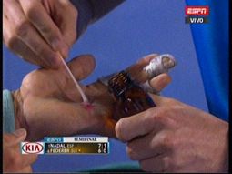 asi quedo la mano de nadal tras destrozar a federer asi quedo la mano de nadal tras destrozar a federer
