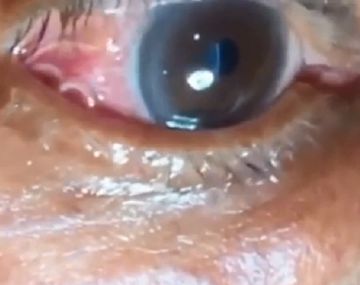Asqueroso: le creció un gusano en el ojo por la picadura de un mosquito