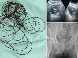 Un hombre se introdujo una cuerda de dos metros por el pene para aumentar su placer sexual