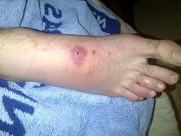 los pies de mayer siguen mostrando las secuelas de la batalla de la davis los pies de mayer siguen mostrando las secuelas de la batalla de la davis