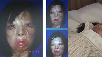 una chica de 17 anos se hizo un trasplante de cara una chica de 17 anos se hizo un trasplante de cara