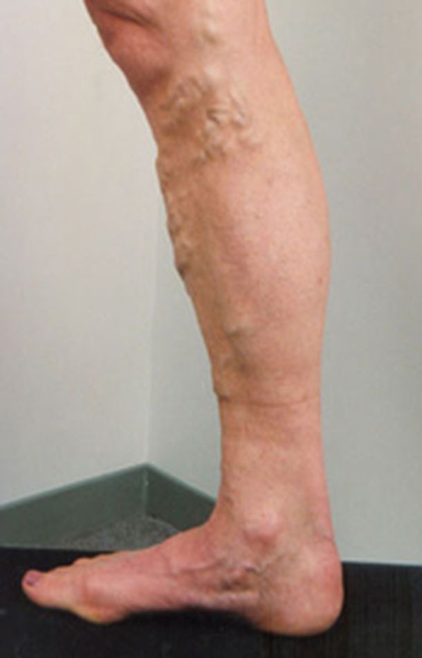 Varices_pierna2 Varices_pierna2