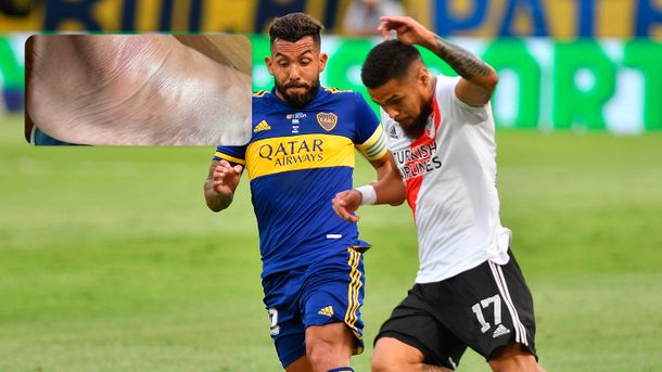 La impactante imagen del tobillo de Tevez tras el Superclásico del domingo