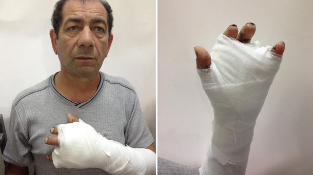 Se cortó los dedos con una amoladora y lograron reconstruirle la mano