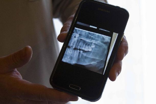 Inédita operación en Viedma: le reconstruyen la mandíbula con partes del peroné