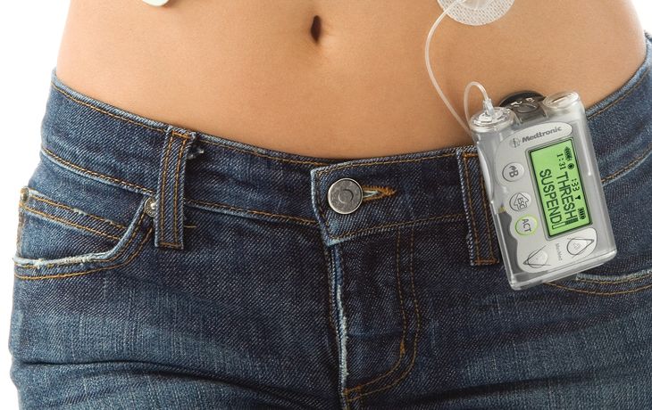 Diabetes: prueban celular como pancreas artificial asociado a un celular